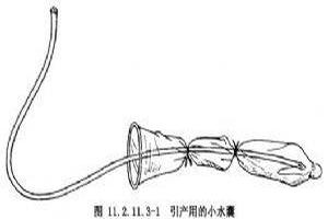 鸡西水囊引产法(水囊引产多少钱) 鸡西水囊引产法(水囊引产多少钱)
