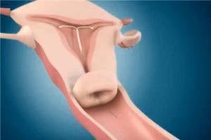 鸡西流产后马上上环(流产后直接上环了后悔可以去了吗?) 鸡西流产后马上上环(流产后直接上环了后悔可以去了吗?)