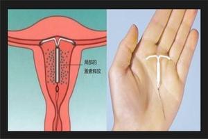 鸡西环取环哪里医院便宜点(鸡西环取环哪里医院便宜点呢) 鸡西环取环哪里医院便宜点(鸡西环取环哪里医院便宜点呢)