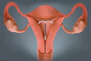 鸡西环不上环(避孕环不上可不可以) 鸡西环不上环(避孕环不上可不可以)