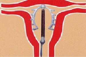 鸡西环妮环上环视频全过程(上环环的价格) 鸡西环妮环上环视频全过程(上环环的价格)