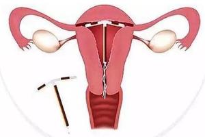 鸡西环上环价格(营口上环多少钱) 鸡西环上环价格(营口上环多少钱)